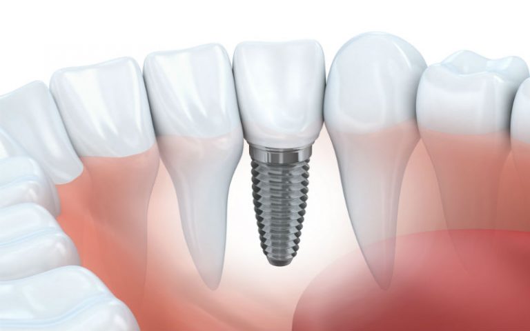 Improve Your Biting and Chewing Ability Using Dental Implant Services In New Lenox